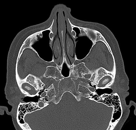 ct paranasal sinuses report template