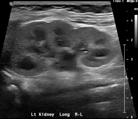 Infant Kidneys Ultrasound – Pediatric Renal | Radiology Template Reports